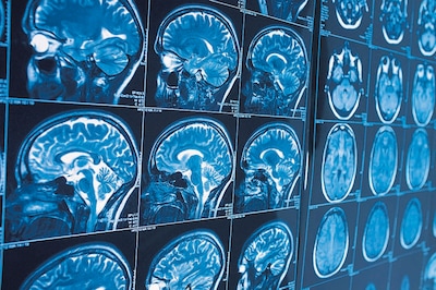 Twents bedrijf werkt aan baanbrekende technologie die medicijnen naar de hersenen kan brengen